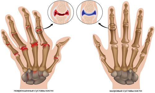 Патологии, выявляемые после проведения рентгена кистей рук
